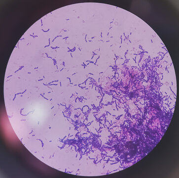 Yeast Infection; Budding yeast and pseudohyphae of Candida albicans, gram's stain. This fungus commonly affects vagina and vulva, oral (thrush) and diaper rash.