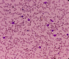 Photomicrograph of hematological slide showing RBC, WBC (Eosinophil) and platelet. Normal hemogram....