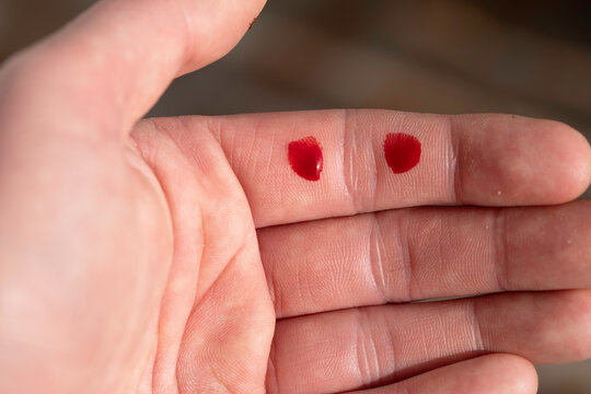 Drops of blood on wounded finger, open palm, hand. Finger cut, bleeding injured with knife, Flesh blood wound in hand.