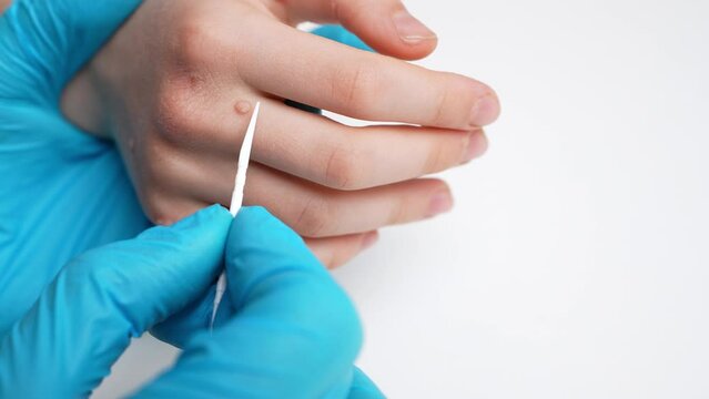  Dermatologist in medical gloves treats a child hand affected by warts with special solution for papillomavirus, close-up. Verruca vulgaris. Papillomavirus, HPV. Concept of skin diseases, HPV control.