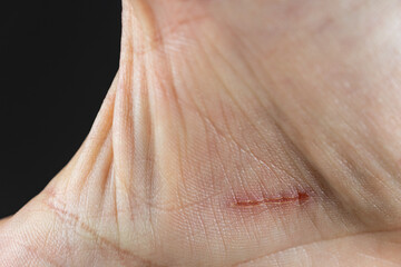 Part of human hand palm with wound caused by plant spikes