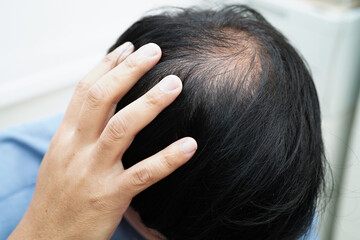 Doctor touch bold head in man, hair loss treatment health problem.