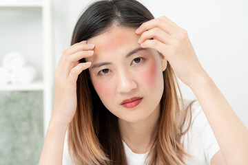 Young woman are worried about faces Dermatology and allergic to steroids in cosmetics. sensitive skin, red face from sunburn, acne, allergic to chemicals, rash on face. skin problems and beauty