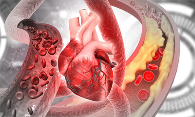 Cholesterol in human heart, Clogged blood vessels,3d illustration