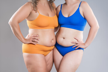 Two overweight women with cellulitis, fat flabby bellies, legs, hands, hips and buttocks on gray background, obese female body, liposuction and plastic surgery concept