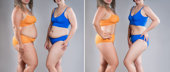 Tummy tuck, woman's fat body with cellulitis before and after weight loss and liposuction, two overweight women on gray background, obese female body, plastic surgery concept - 779510003