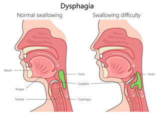 dysphagia swallowing difficulty and normal swallowing with labeled anatomy structure vertebral column diagram hand drawn schematic raster illustration. Medical science educational illustration - obrazy, fototapety, plakaty