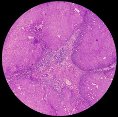 Breast cancer. Invasive squamous cell carcinoma of areola of breast. Show skin and soft tissue....