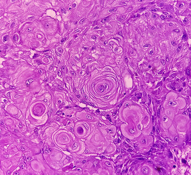 Breast cancer. Invasive squamous cell carcinoma of areola of breast. Show skin and soft tissue. malignant neoplasm of atypical squamous epithelial cells.