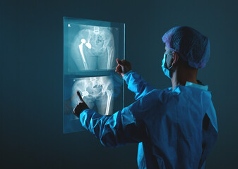 Doctor looking at total hip replacement X-ray film with blurred hospital background.