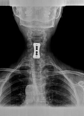 Film xray or radiograph of a cervical neck. AP anterior posterior view showing surgical bracket to...