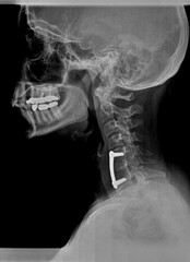 Film xray or radiograph of a cervical neck. Lateral side view showing surgical bracket to help...