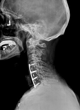 Film xray or radiograph of a cervical neck. Lateral side view showing surgical bracket to help stabilize the patients neck