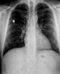 Chest xray of of patient with emphysematous lungs, hilar  adenopathy showing heart, vertebrae and...