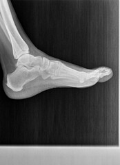 Film xray or radiograph of a normal foot, ankle and leg. Lateral view show normal bone structure of joint space is normal