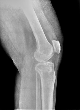 Film xray or radiograph of a normal knee. Lateral view show normal bone structure of patella femur tibia and fibula, joint space is normal with a fabella aka joint mice seen in the posterior