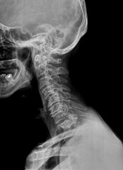 Film x ray or radiograph of a cervical neck in an elderly patient. Lateral side view showing...