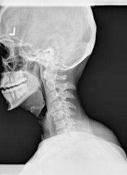 Film x ray or radiograph of a cervical neck. Lateral side view showing straightening or slight kyphosis normally seen after a whiplash injury with degneration of C4 and C5 disc