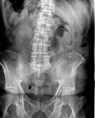 Film x ray or radiograph of an adult lumbar vertebrae anterior posterior AP view showing a very...