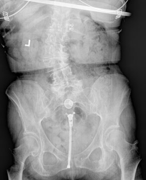 Film x ray or radiograph of a normal adult lumbar vertebrae anterior posterior AP view showing moderate to severe left side convexity scoliosis or S curvature of the spine