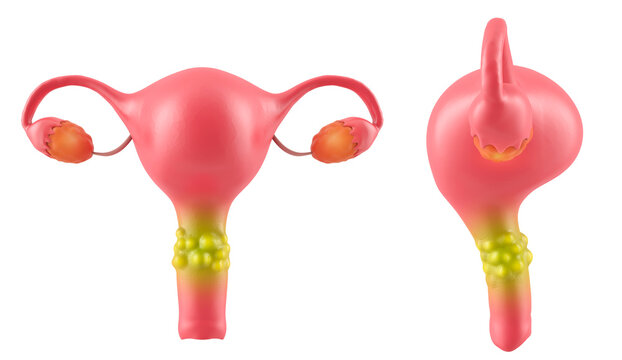 Female reproductive system, Uterus with damaged cervix, cellular tissue with cancer. 3D Render