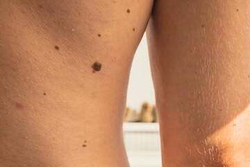Male showing birthmarks on skin body back part. Close up detail of the bare skin. Health Effects of UV Radiation. Man with birthmarks Pigmentation and lot of birthmarks