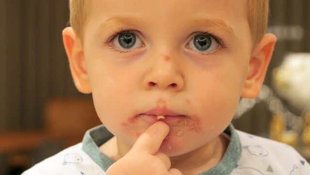 Cute Little Boy with Impetigo Contagious Skin Infection - Close Up