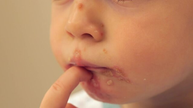 Baby Scratching His Chin With Impetigo - Bacterial Skin Infection. - closeup shot