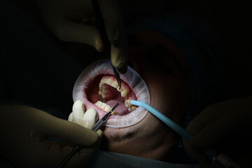 Installation of a dental implant. Dentistry and the concept of dental care. Modern dentistry.