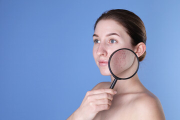 Young woman with acne problem holding magnifying glass near her skin on blue background. Space for...