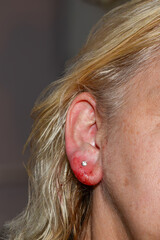 Inflamed earlobe after ear piercing