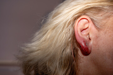 Inflamed earlobe after ear piercing - 780360431