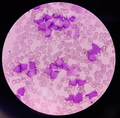 Acute leukemia, ALL(Acute lymphoblastic leukemia), peripheral blood smear, Under 100x light...