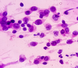 Pap's smear. Inflammatory smear with HPV related changes. Cervical cancer. SCC.