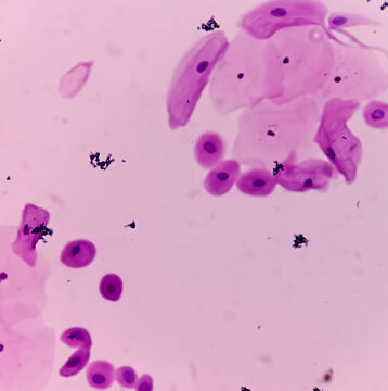 Pap's smear. Inflammatory smear with HPV related changes. Cervical cancer. SCC.