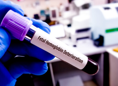 Kleihauer&ndash;Betke test or Kleihauer test, is utilized to determine if there is fetal blood in maternal circulation, Foeto-maternal haemorrhage (FMH).