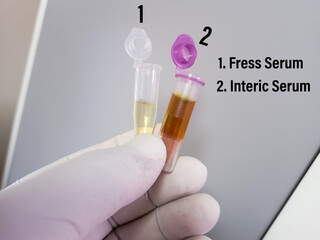 Scientist hold sample cup with icteric serum for test in laboratory. Hyperbilirubinemia, which can cause false laboratory test result.