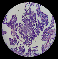 Microscopic image of Papillary borderline serous tumor of the ovary (low malignant potential) with...