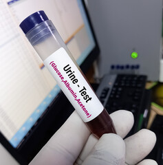 Urine sample in test vial for urine examination in hospital laboratory, urine test for glucose,...