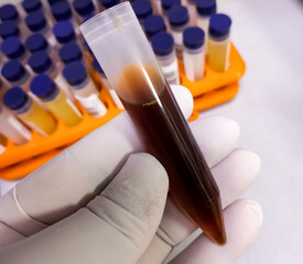 Dark yellow colour urine sample for urine analysis at laboratory. Medical urine test, close-up.