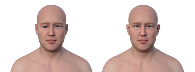 A man with hypotropia and a healthy person, 3D illustration