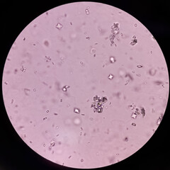 UTI. Budding yeast cells and calcium oxalate crystal in urine, urinary tract infections.
