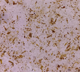 Microscopic image of urine granular cast and cellular cast, cause of exercise or dehydration Acute...