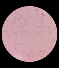 Microscopic image of urine sediment show epithelial cells. UTI. urine analysis.