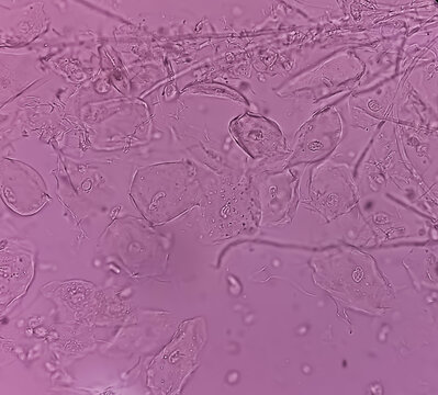 Pseudo hyphae and budding yeast cells in patient urine (urinary tract infections), photomicrograph by microscope.