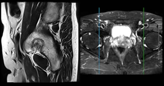 MRI of the prostate gland reveals A 2.0x0.9x1.7 cm malignant prostate tumor at left posterior PZ, aiding in diagnosing tumors and guiding treatment decisions.