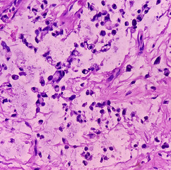 Bone cancer. Chondroblastic osteosarcoma. It's very rare cancer, microscopically show atypical mesenchymal cells, bizarre cells.