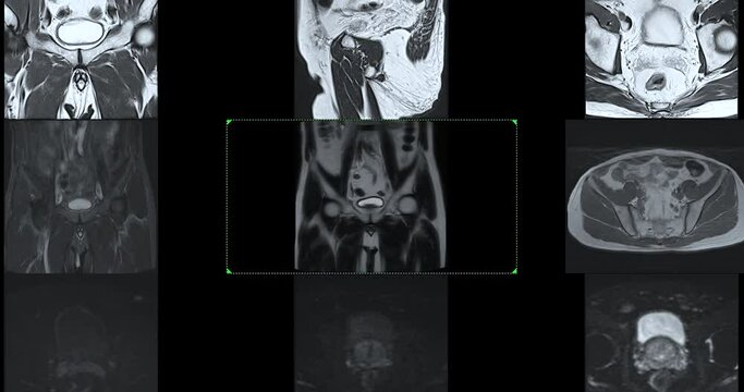 MRI of the prostate gland, revealing an enlarged size, aids in diagnosing tumors, guiding treatment decisions, and monitoring prostate health.