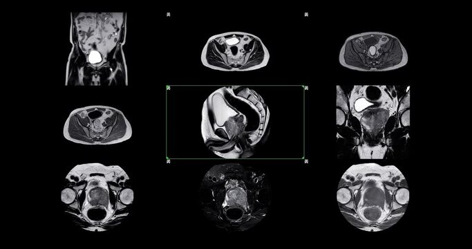 
MRI of the prostate gland reveals a focal abnormal signal intensity (SI) lesion at the left posterolateral peripheral zones at the apex, aiding in diagnosing tumors and guiding treatment decisions.