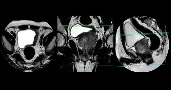 
MRI of the prostate gland reveals a focal abnormal signal intensity (SI) lesion at the left posterolateral peripheral zones at the apex, aiding in diagnosing tumors and guiding treatment decisions.